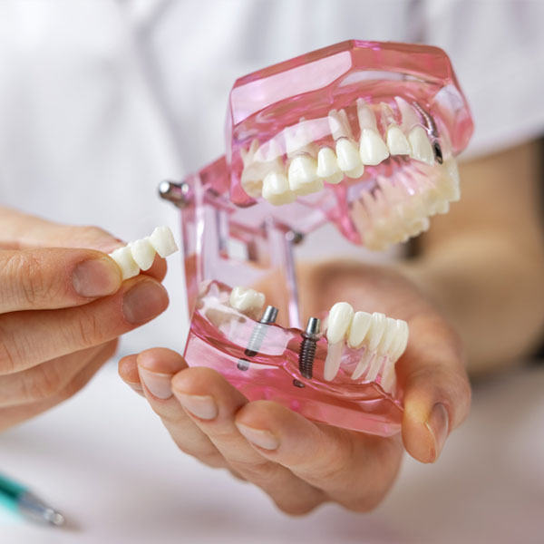 Dental Implants & Prosthetics